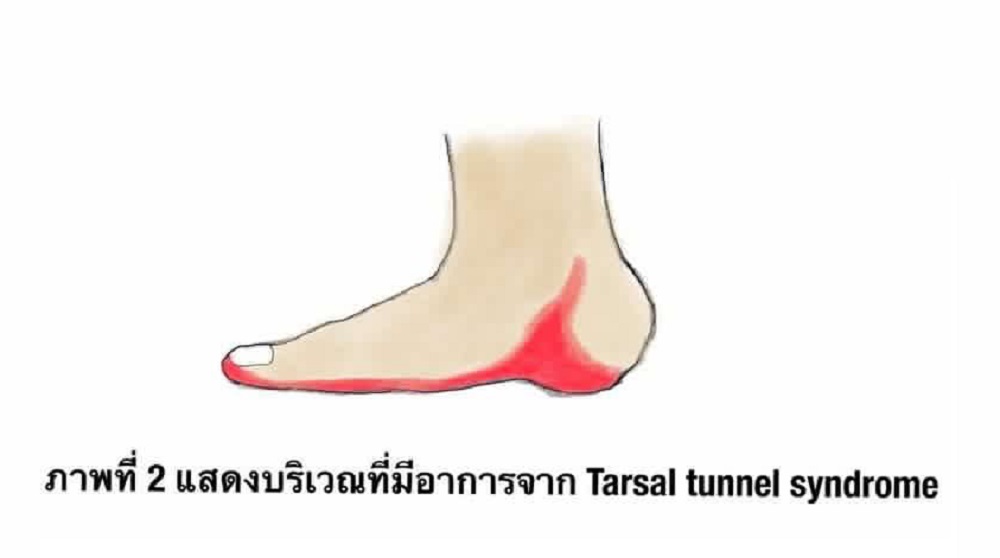 ภาพที่ 2 แสดงบริเวณที่มีอาการ Tasal tunnel syndrome