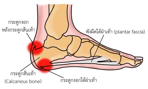 Calcaneal spure (ภาวะกระดูกอ่อนงอกที่ส้นเท้า) – ศูนย์กายภาพบำบัด คณะ ...