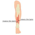 “Shin Splints” กล้ามเนื้อหน้าแข้งอักเสบ ปัญหาที่พบได้ในนักวิ่ง – ศูนย์ ...