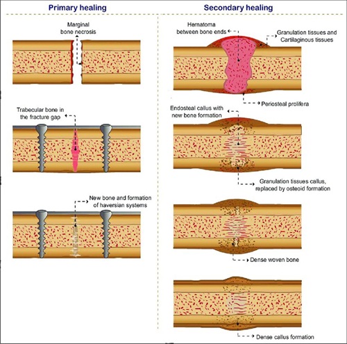 รูปที่ 1 Primary and secondary bone healing