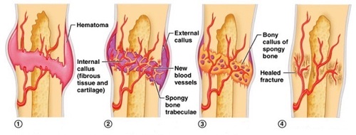 รูปที่ 2 Secondary bone healing (1) Hematoma Formation (2) Soft callus formation (3) Hard callus formation (4) Bone remodeling